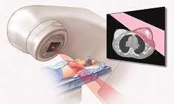 رادیوتراپی سرطان سینه: روش پرتودرمانی و عوارض احتمالی